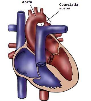 Stenozele pulmonare